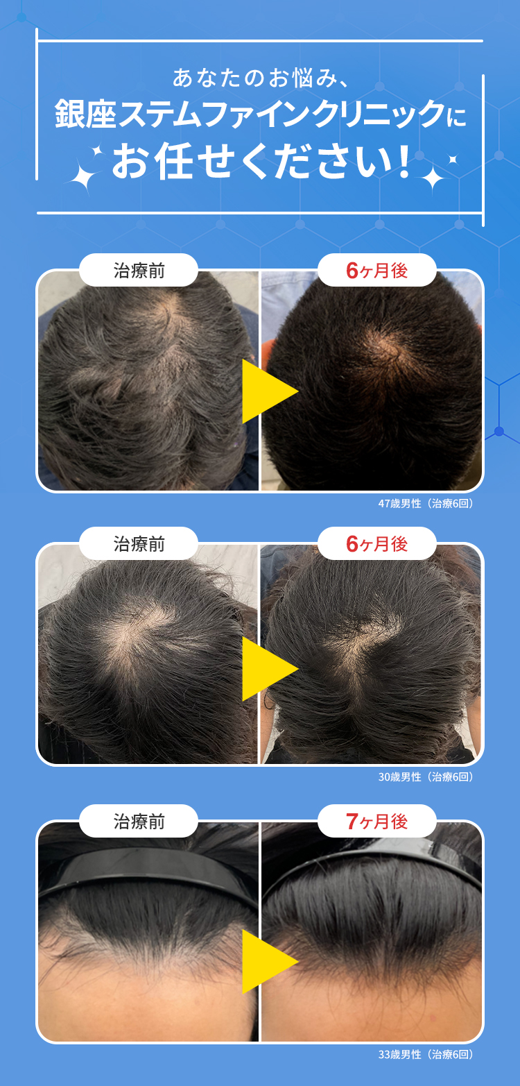 2025年最新】毛髪再生医療（AGAメソセラピー）とは？｜治療の流れと気