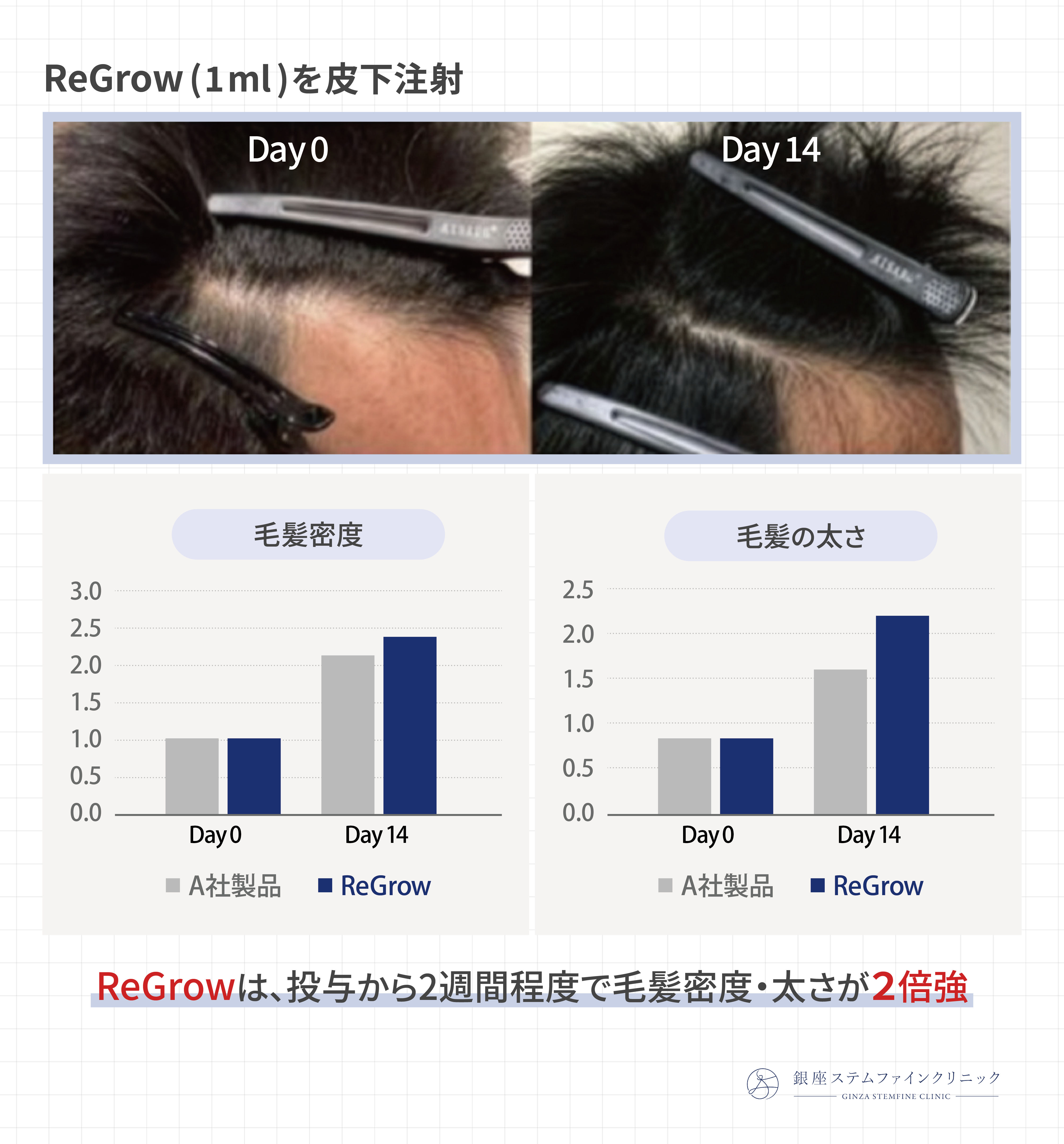 毛髪再生医療の実用化はいつ始まる？→答え：もう始まってます